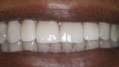 Close up of flawless smile after veneers and Lumineers