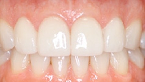 Close up of flawless smile after veneers and Lumineers