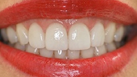 Close up of flawless smile after veneers and Lumineers