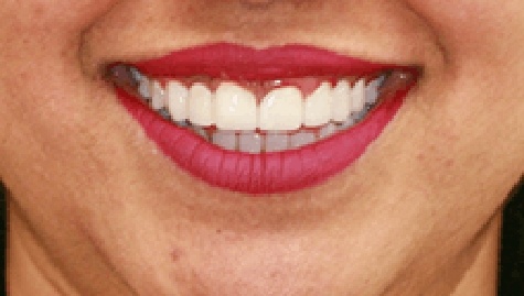 Close up of flawless smile after veneers and Lumineers