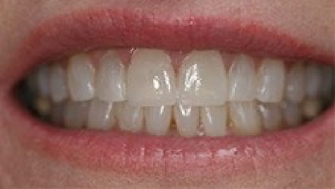 Close up of flawless smile after veneers and Lumineers