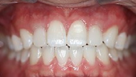 Close up of flawless smile after veneers and Lumineers