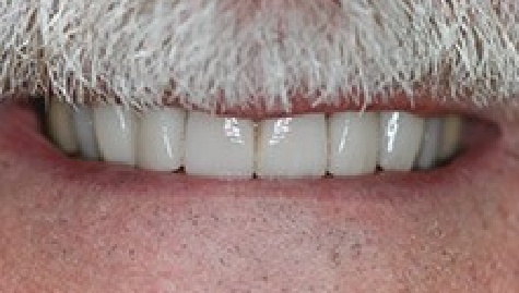 Close up of flawless smile after veneers and Lumineers