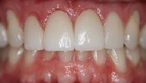 Close up of flawless smile after veneers and Lumineers