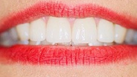 Close up of flawless smile after veneers and Lumineers