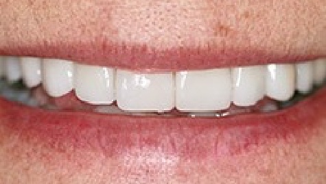 Close up of flawless smile after veneers and Lumineers