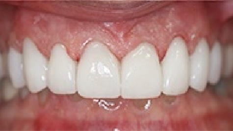 Close up of flawless smile after veneers and Lumineers