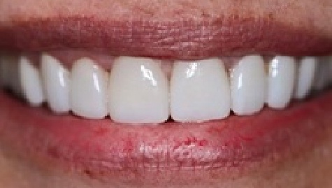 Close up of flawless smile after veneers and Lumineers