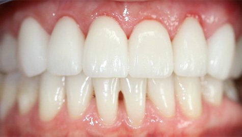 Close up of flawless smile after veneers and Lumineers