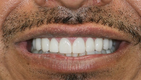 Close up of flawless smile after veneers and Lumineers