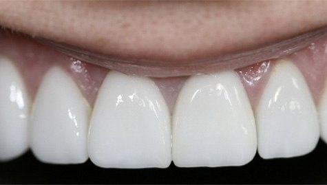 Close up of flawless smile after veneers and Lumineers