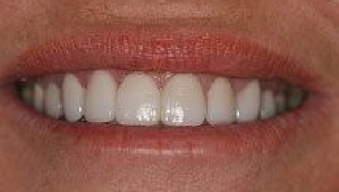 Close up of flawless smile after veneers and Lumineers