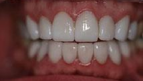 Close up of flawless smile after veneers and Lumineers