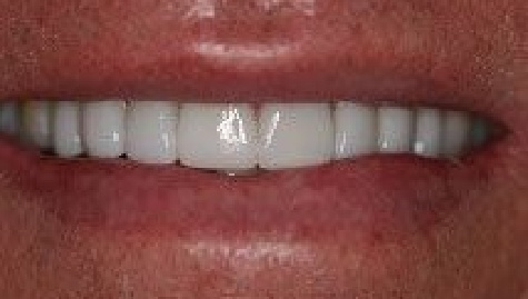 Close up of flawless smile after veneers and Lumineers