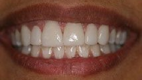 Close up of flawless smile after veneers and Lumineers