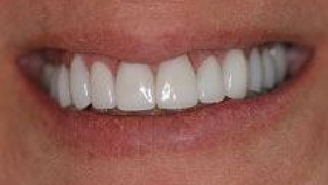 Close up of flawless smile after veneers and Lumineers