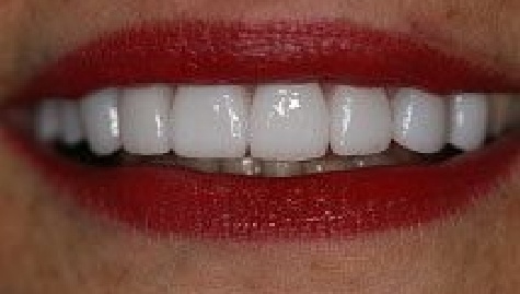 Close up of flawless smile after veneers and Lumineers