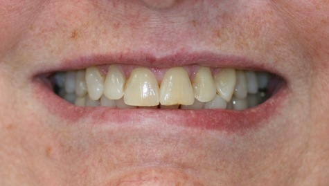 Close up of imperfect teeth before veneers and Lumineers