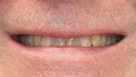 Close up of imperfect teeth before veneers and Lumineers