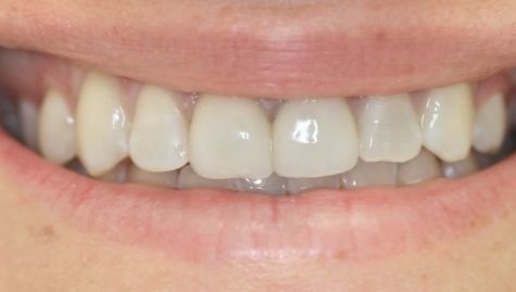 Close up of imperfect teeth before veneers and Lumineers