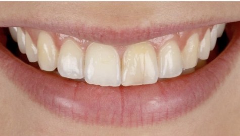 Close up of imperfect teeth before veneers and Lumineers