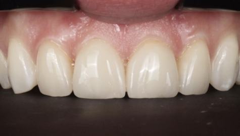 Close up of imperfect teeth before veneers and Lumineers