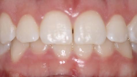 Close up of imperfect teeth before veneers and Lumineers