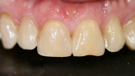 Close up of imperfect teeth before veneers and Lumineers