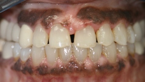 Close up of imperfect teeth before veneers and Lumineers