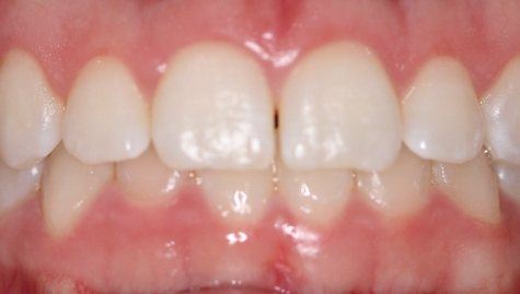 Close up of imperfect teeth before veneers and Lumineers