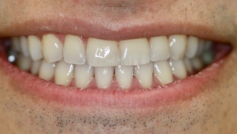 Close up of imperfect teeth before veneers and Lumineers