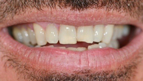 Close up of imperfect teeth before veneers and Lumineers