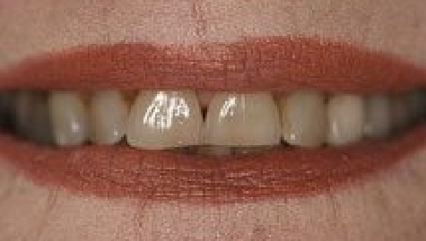 Close up of imperfect teeth before veneers and Lumineers