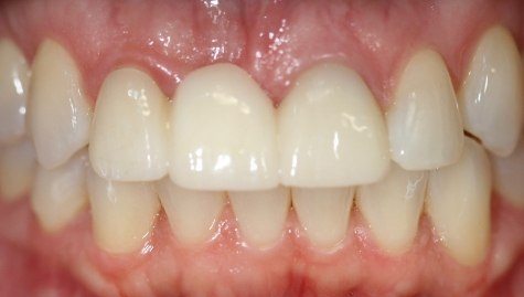 Close up of imperfect teeth before veneers and Lumineers