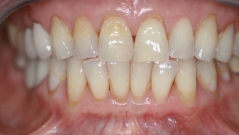 Close up of imperfect teeth before veneers and Lumineers