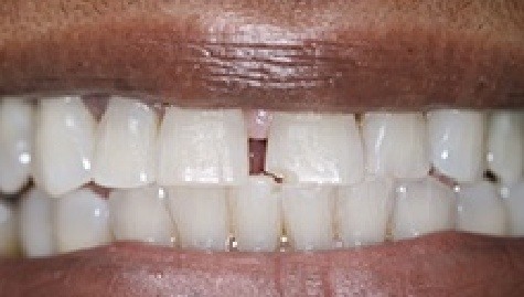 Close up of imperfect teeth before veneers and Lumineers