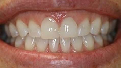 Close up of imperfect teeth before veneers and Lumineers