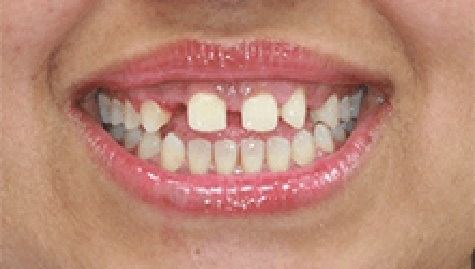 Close up of imperfect teeth before veneers and Lumineers