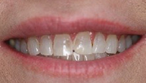 Close up of imperfect teeth before veneers and Lumineers