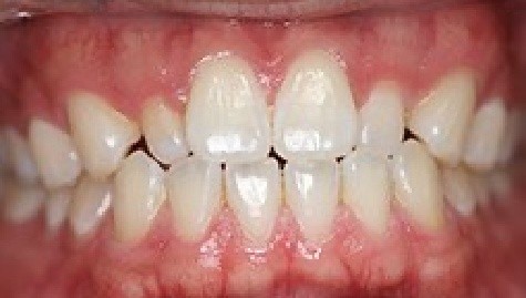 Close up of imperfect teeth before veneers and Lumineers