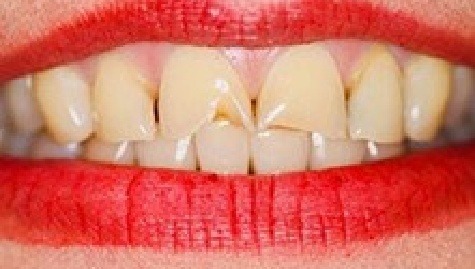 Close up of imperfect teeth before veneers and Lumineers