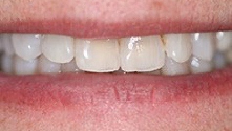 Close up of imperfect teeth before veneers and Lumineers