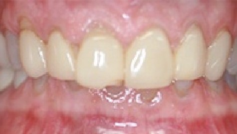 Close up of imperfect teeth before veneers and Lumineers