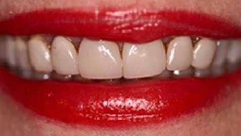 Close up of imperfect teeth before veneers and Lumineers