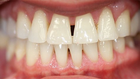 Close up of imperfect teeth before veneers and Lumineers