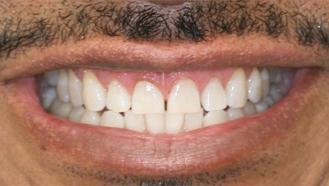 Close up of imperfect teeth before veneers and Lumineers