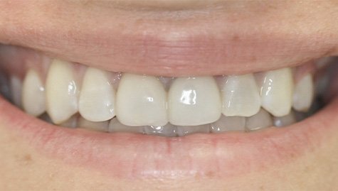 Close up of imperfect teeth before veneers and Lumineers