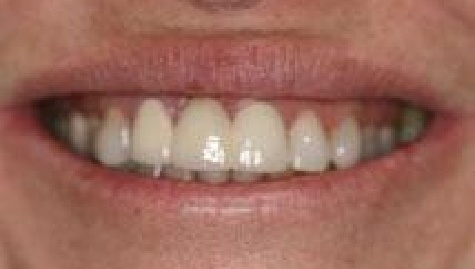 Close up of imperfect teeth before veneers and Lumineers