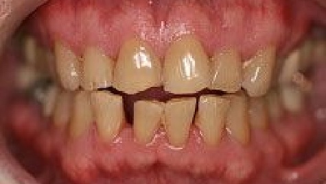 Close up of imperfect teeth before veneers and Lumineers