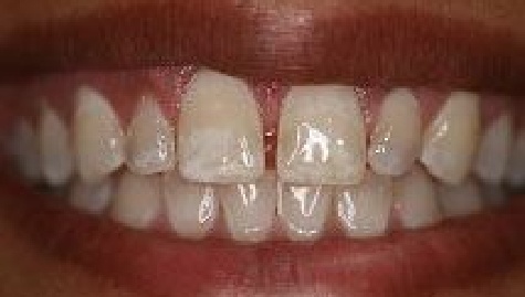 Close up of imperfect teeth before veneers and Lumineers